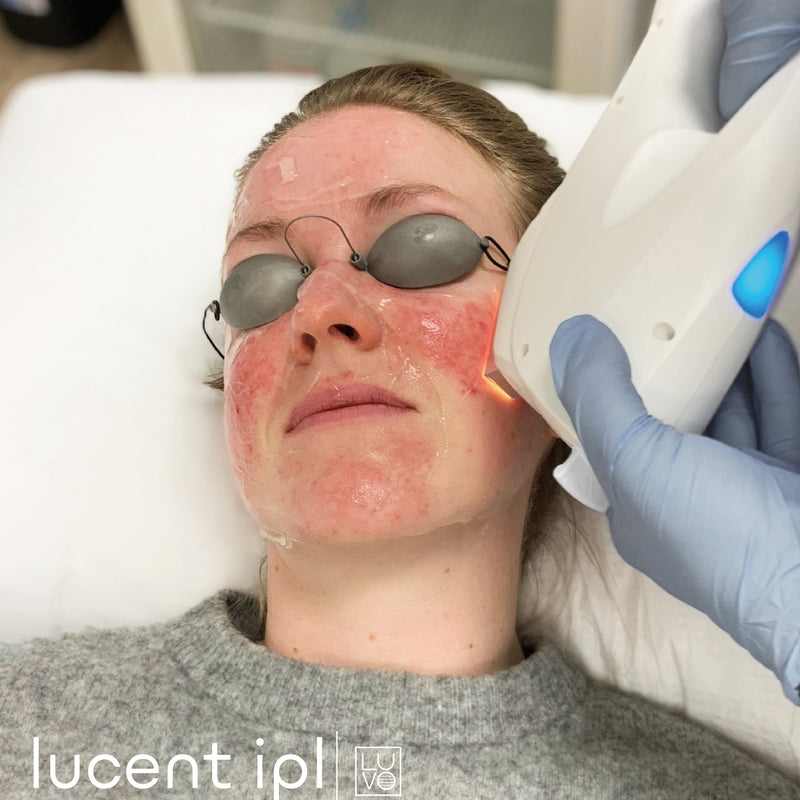 photorajeunissement-ipl-visage-299
